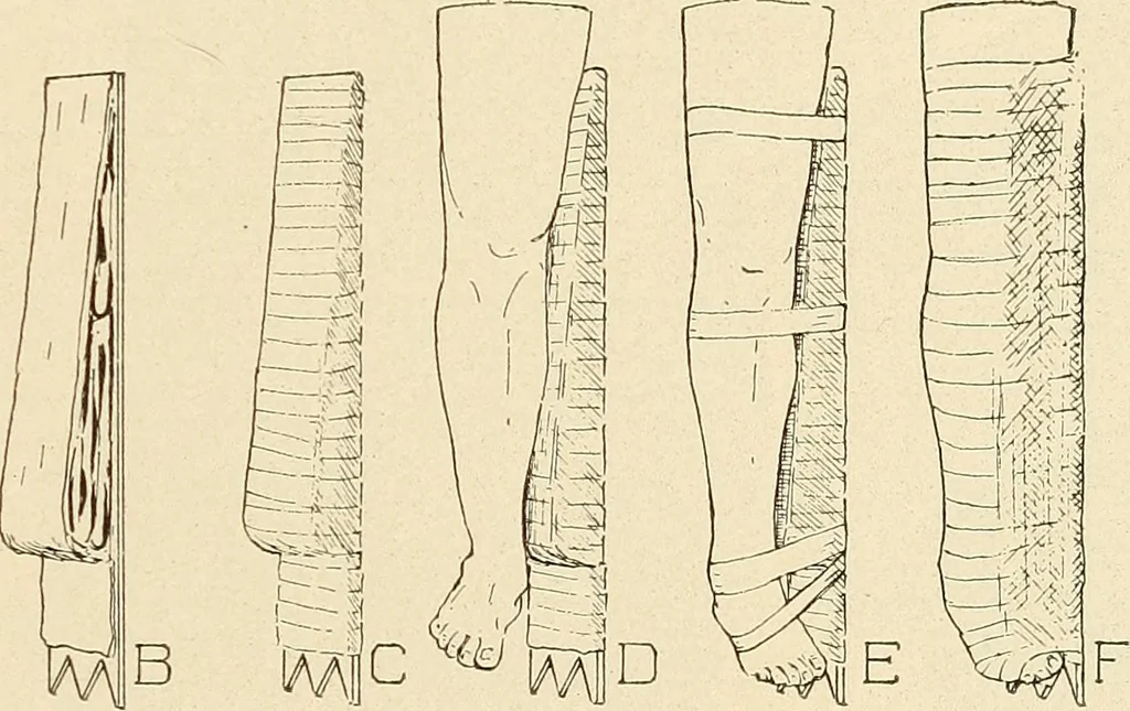 An illustration from Fractures and dislocations, diagnosis and treatment, 1915, leaf 698