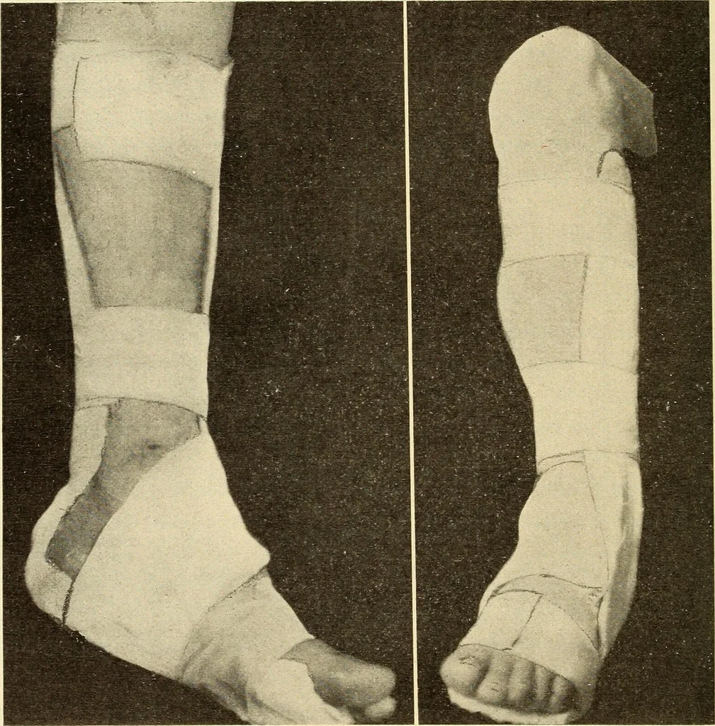 An illustration from Fractures and dislocations, diagnosis and treatment, 1915, leaf 699