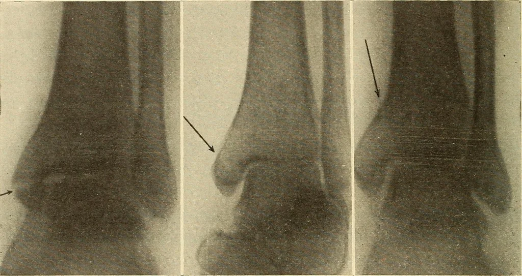An illustration from Fractures and dislocations, diagnosis and treatment, 1915, leaf 705