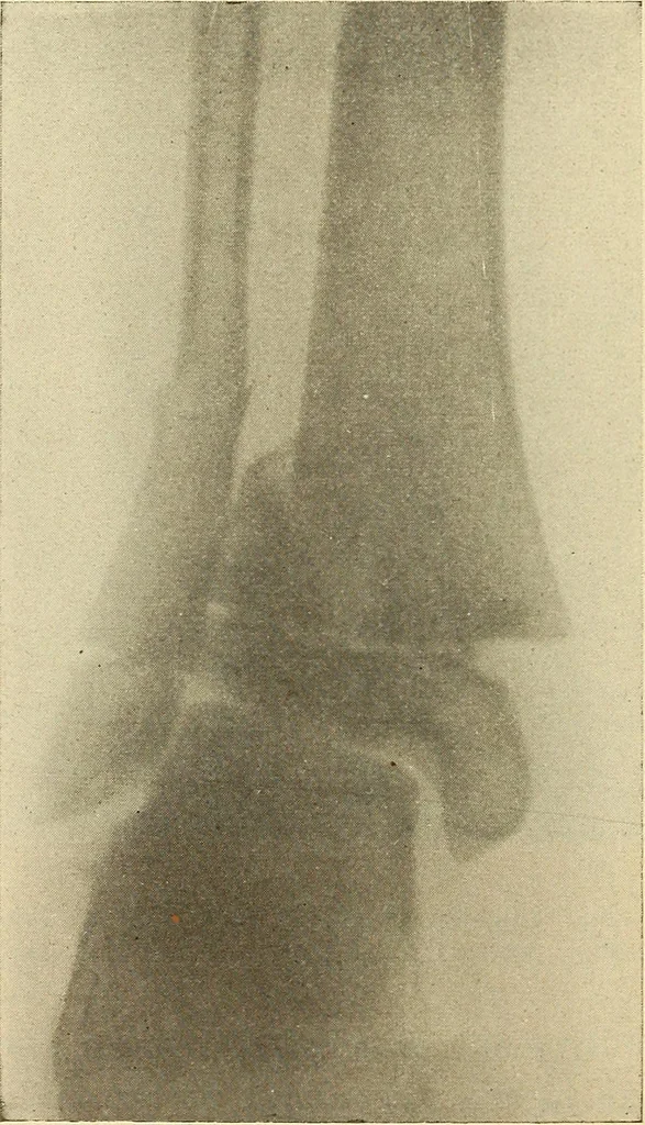 An illustration from Fractures and dislocations, diagnosis and treatment, 1915, leaf 705
