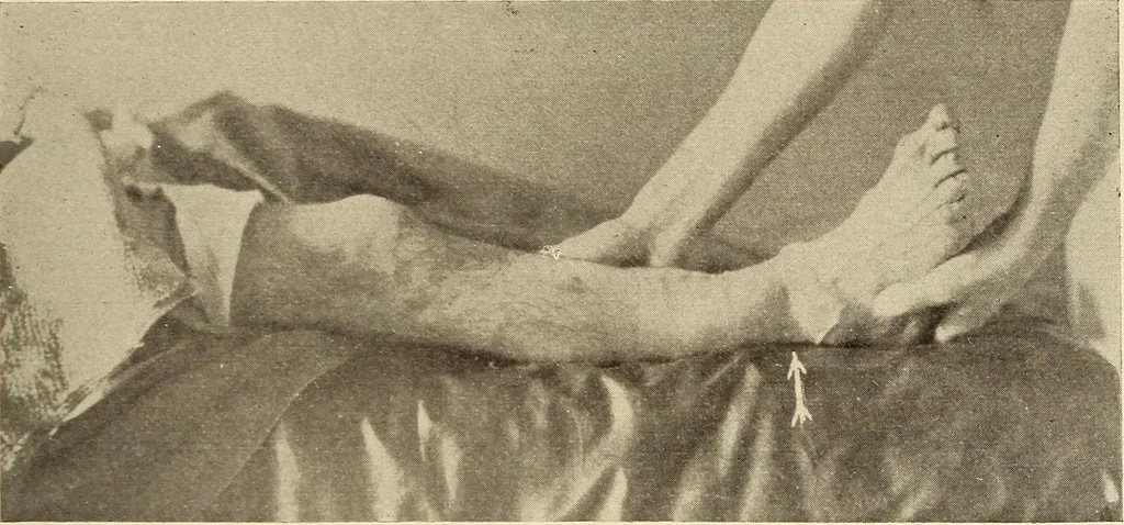 An illustration from Fractures and dislocations, diagnosis and treatment, 1915, leaf 706