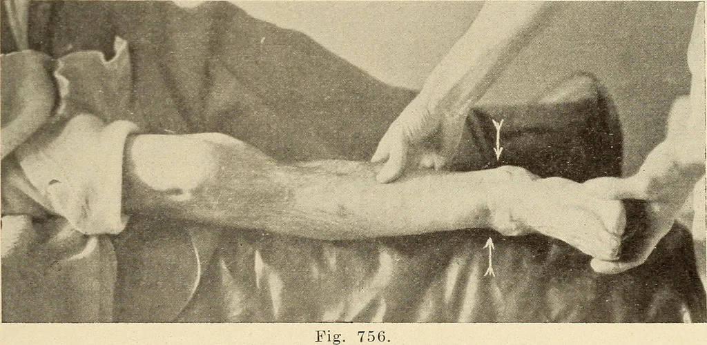 An illustration from Fractures and dislocations, diagnosis and treatment, 1915, leaf 706