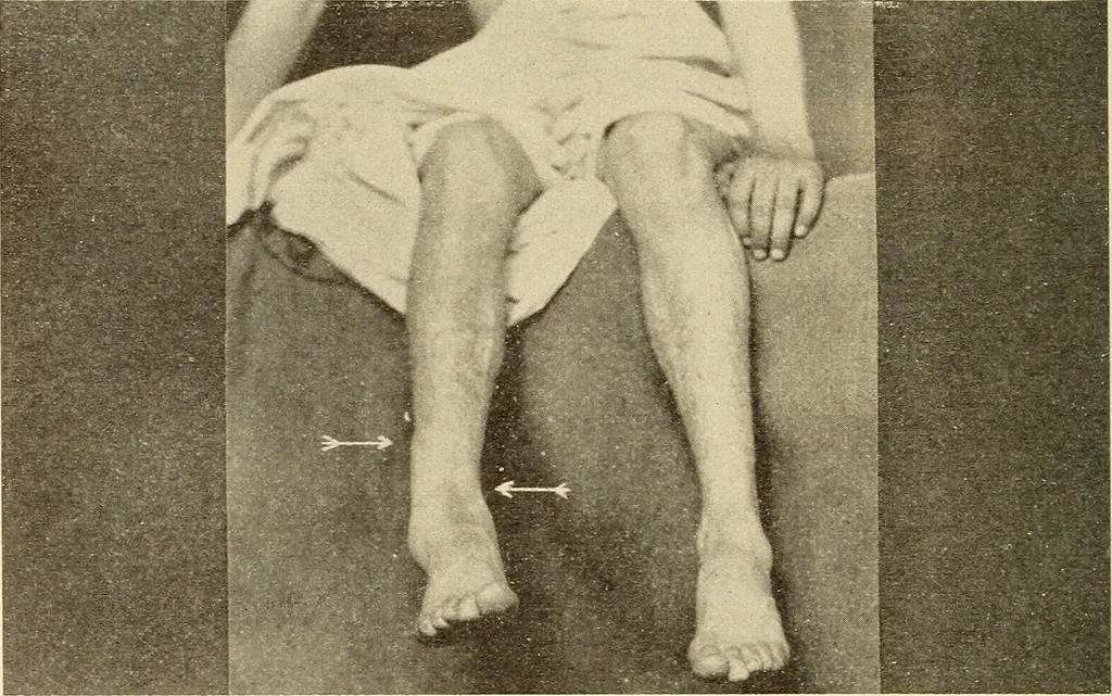 An illustration from Fractures and dislocations, diagnosis and treatment, 1915, leaf 707