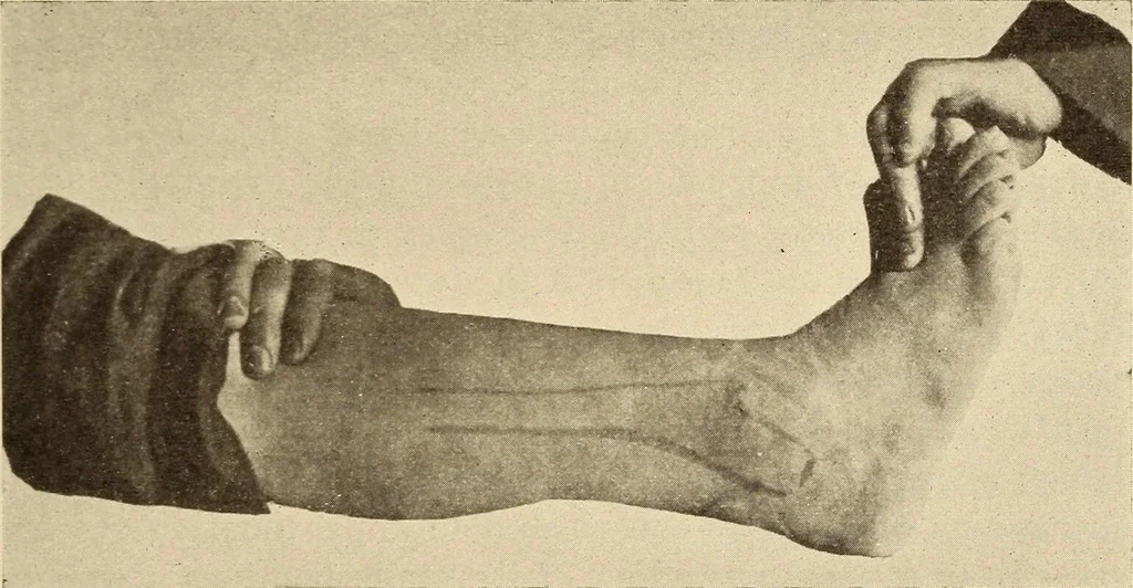 An illustration from Fractures and dislocations, diagnosis and treatment, 1915, leaf 710