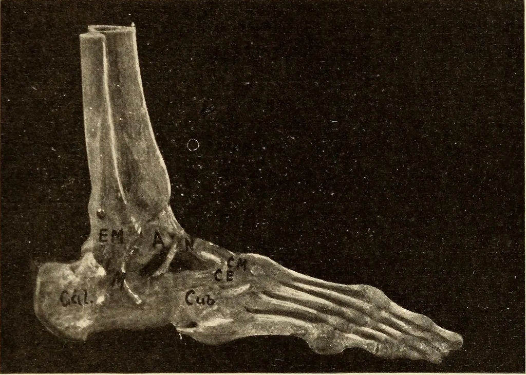 An illustration from Fractures and dislocations, diagnosis and treatment, 1915, leaf 714
