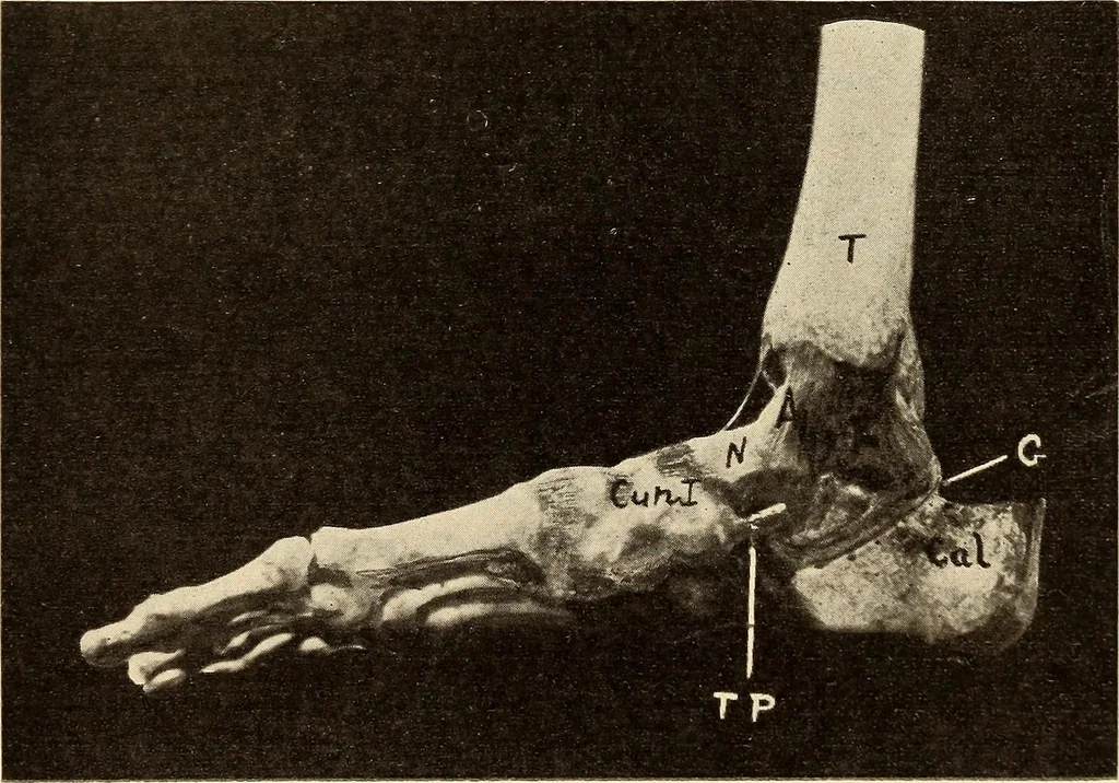 An illustration from Fractures and dislocations, diagnosis and treatment, 1915, leaf 714