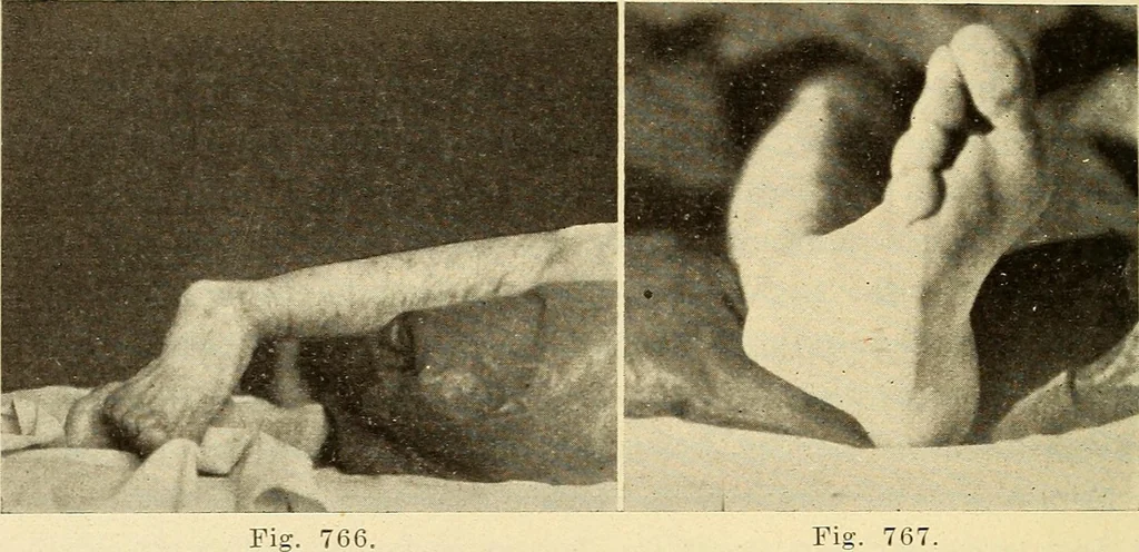 An illustration from Fractures and dislocations, diagnosis and treatment, 1915, leaf 717