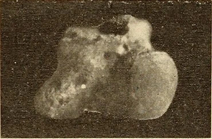 An illustration from Fractures and dislocations, diagnosis and treatment, 1915, leaf 726