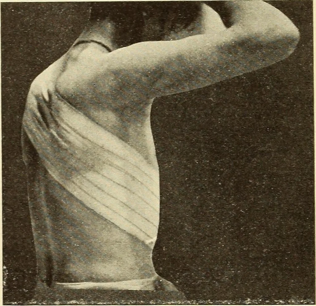 An illustration from Fractures and dislocations, diagnosis and treatment, 1915, leaf 73