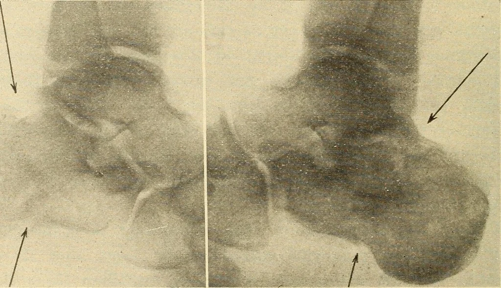 An illustration from Fractures and dislocations, diagnosis and treatment, 1915, leaf 733