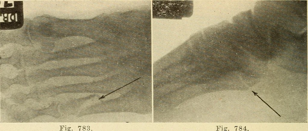 An illustration from Fractures and dislocations, diagnosis and treatment, 1915, leaf 745
