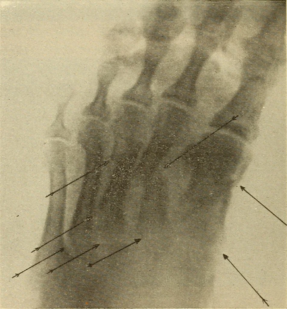 An illustration from Fractures and dislocations, diagnosis and treatment, 1915, leaf 745