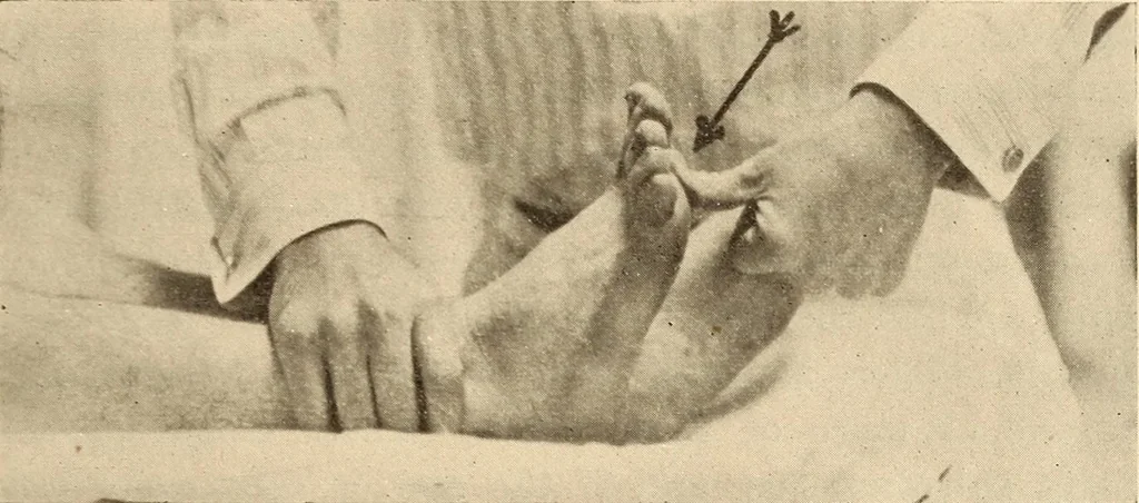 An illustration from Fractures and dislocations, diagnosis and treatment, 1915, leaf 746