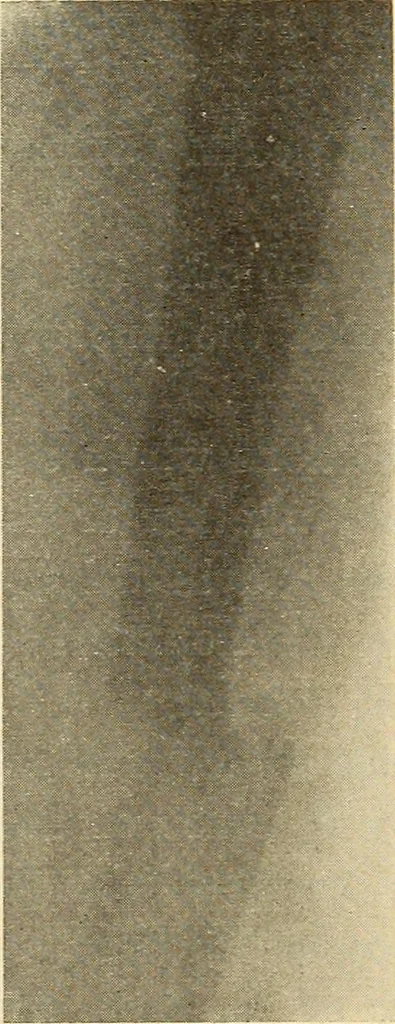 An illustration from Fractures and dislocations, diagnosis and treatment, 1915, leaf 755