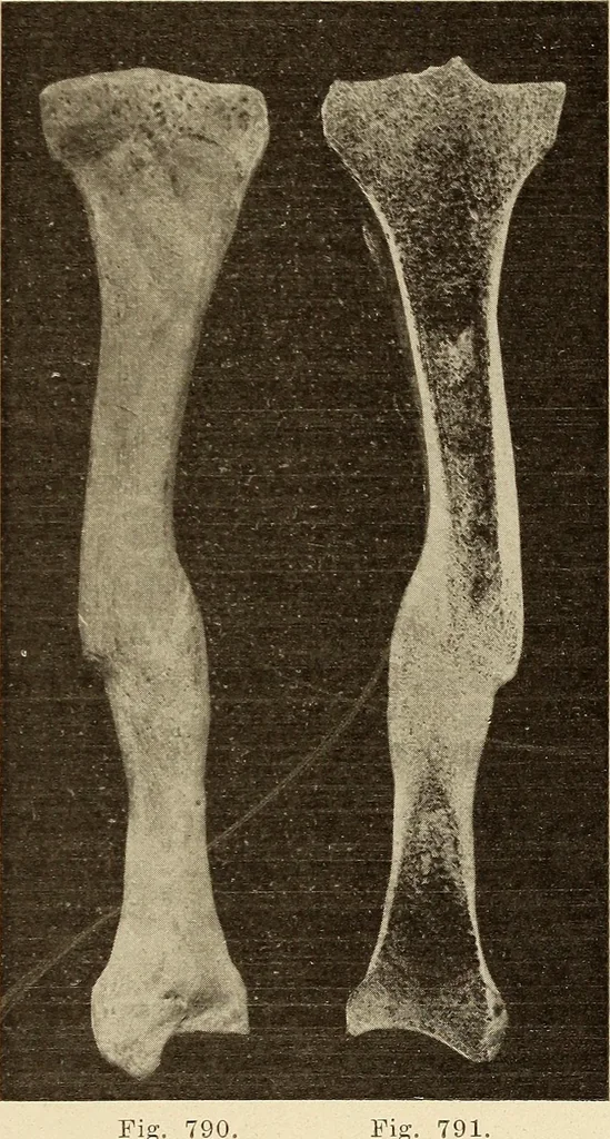 An illustration from Fractures and dislocations, diagnosis and treatment, 1915, leaf 756