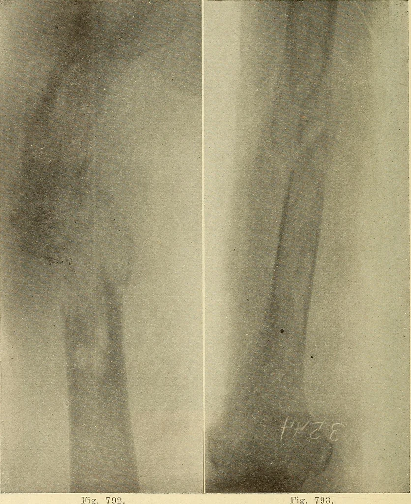 An illustration from Fractures and dislocations, diagnosis and treatment, 1915, leaf 757
