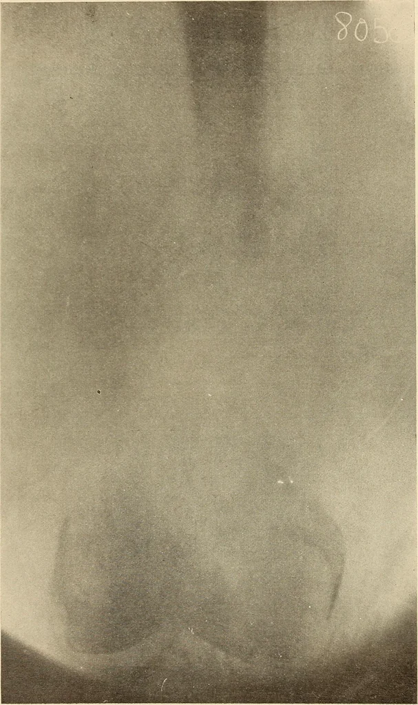 An illustration from Fractures and dislocations, diagnosis and treatment, 1915, leaf 758