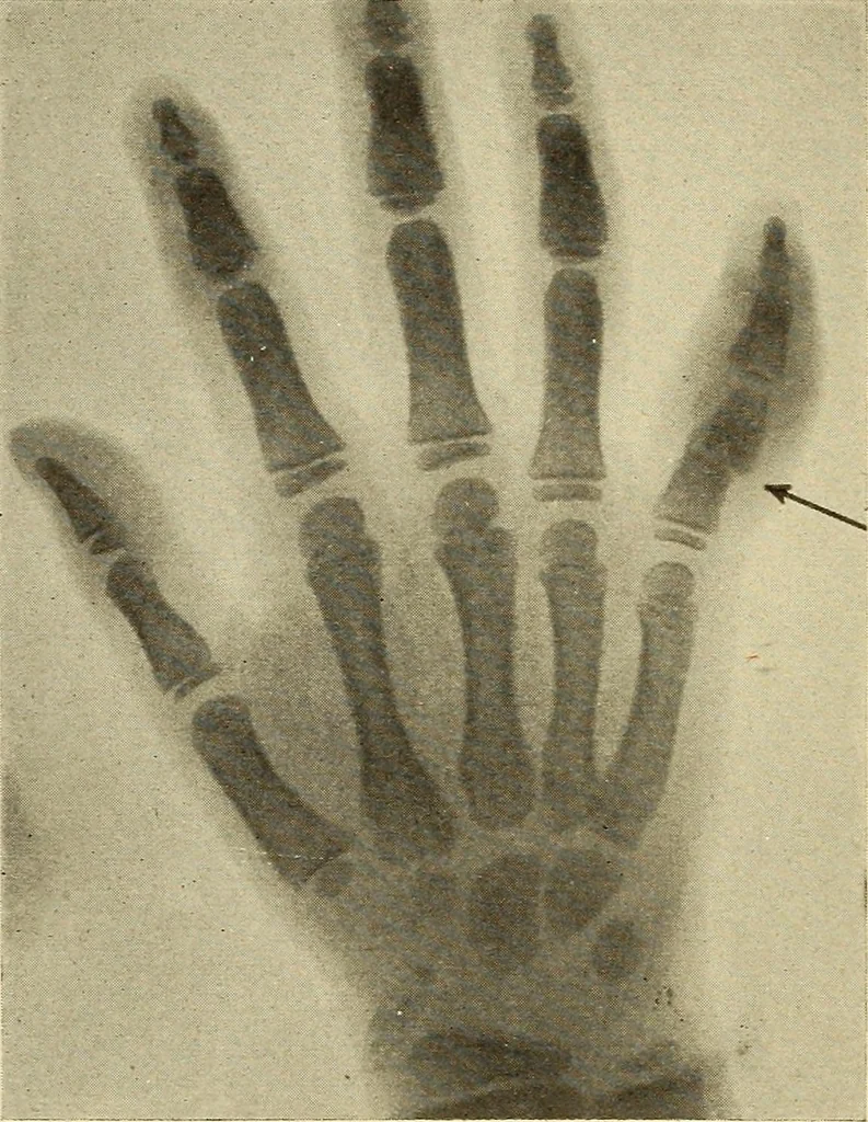An illustration from Fractures and dislocations, diagnosis and treatment, 1915, leaf 759