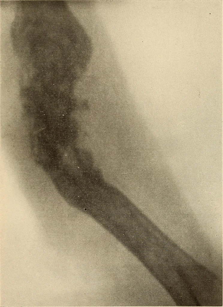 An illustration from Fractures and dislocations, diagnosis and treatment, 1915, leaf 760