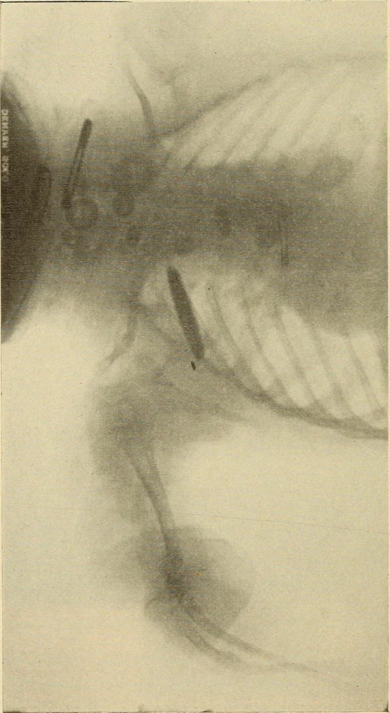 An illustration from Fractures and dislocations, diagnosis and treatment, 1915, leaf 761