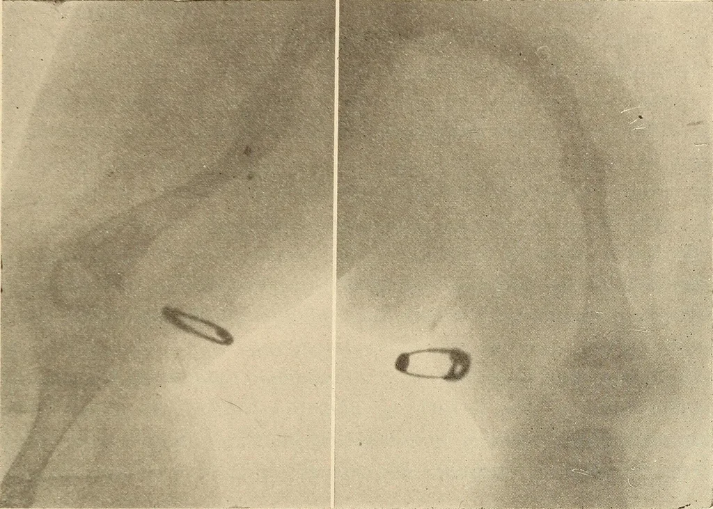 An illustration from Fractures and dislocations, diagnosis and treatment, 1915, leaf 762