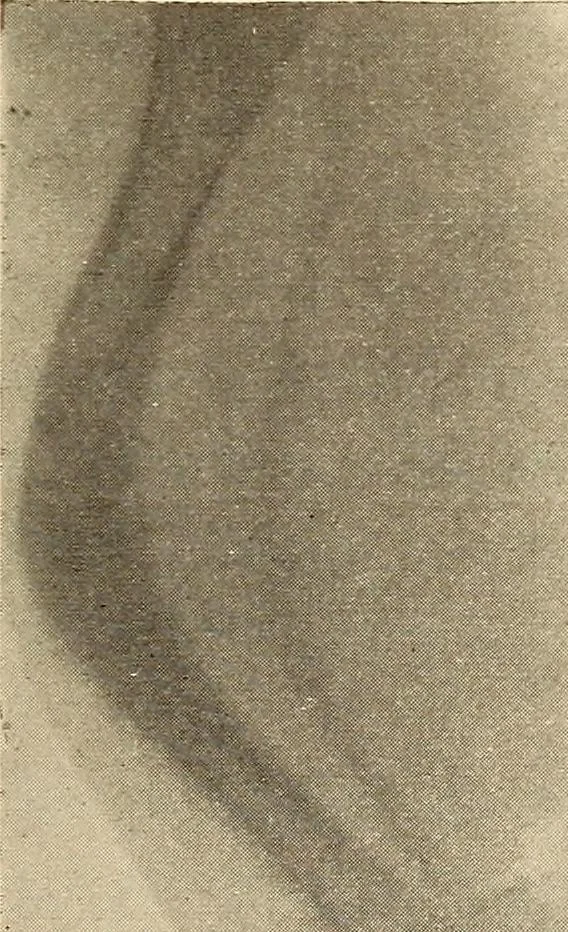 An illustration from Fractures and dislocations, diagnosis and treatment, 1915, leaf 762