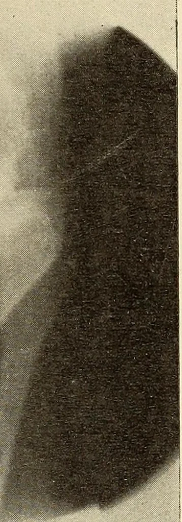 An illustration from Fractures and dislocations, diagnosis and treatment, 1915, leaf 776