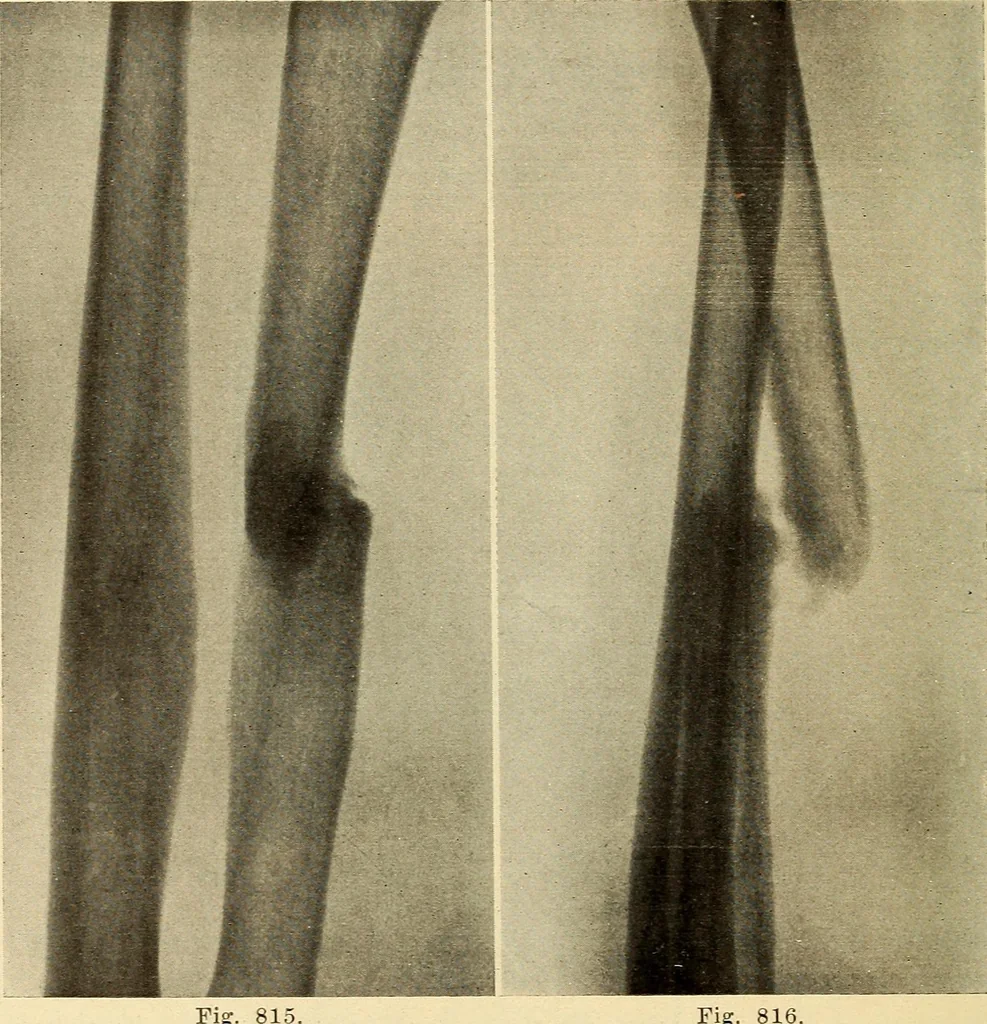 An illustration from Fractures and dislocations, diagnosis and treatment, 1915, leaf 777