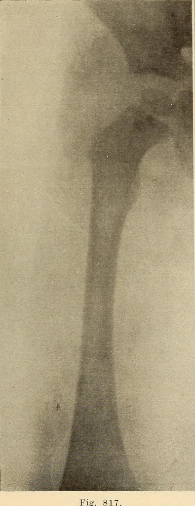 An illustration from Fractures and dislocations, diagnosis and treatment, 1915, leaf 778