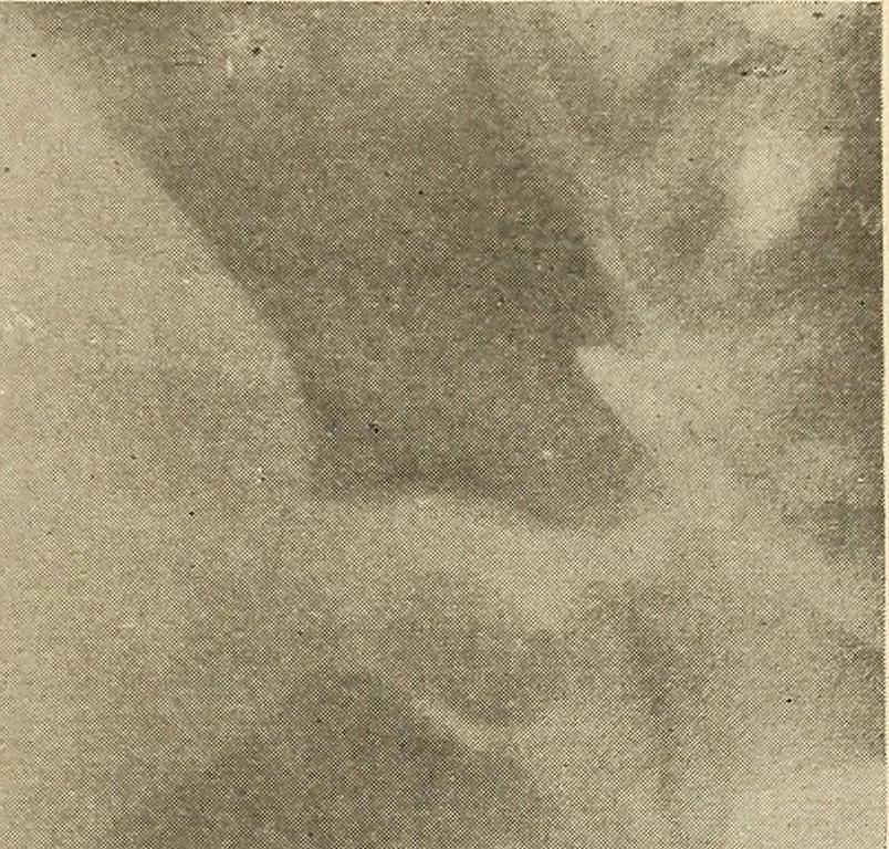 An illustration from Fractures and dislocations, diagnosis and treatment, 1915, leaf 778