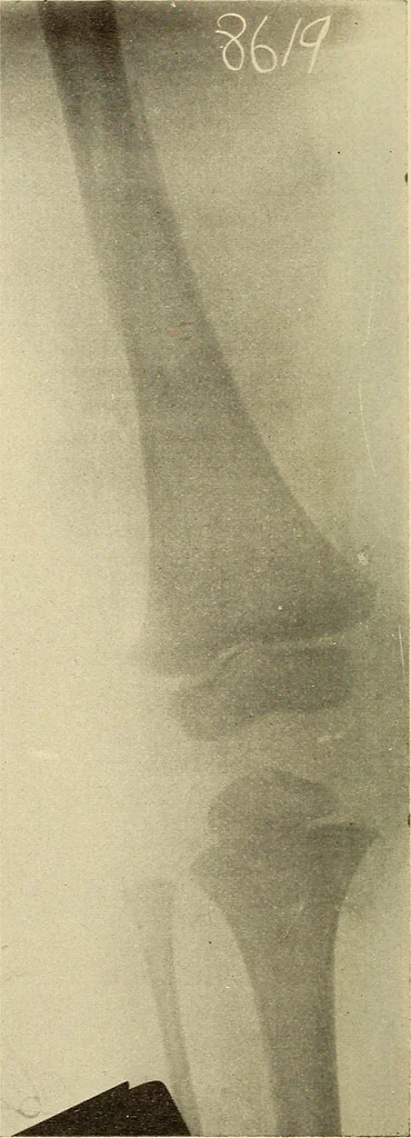 An illustration from Fractures and dislocations, diagnosis and treatment, 1915, leaf 779
