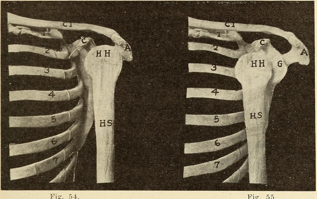 An illustration from Fractures and dislocations, diagnosis and treatment, 1915, leaf 78
