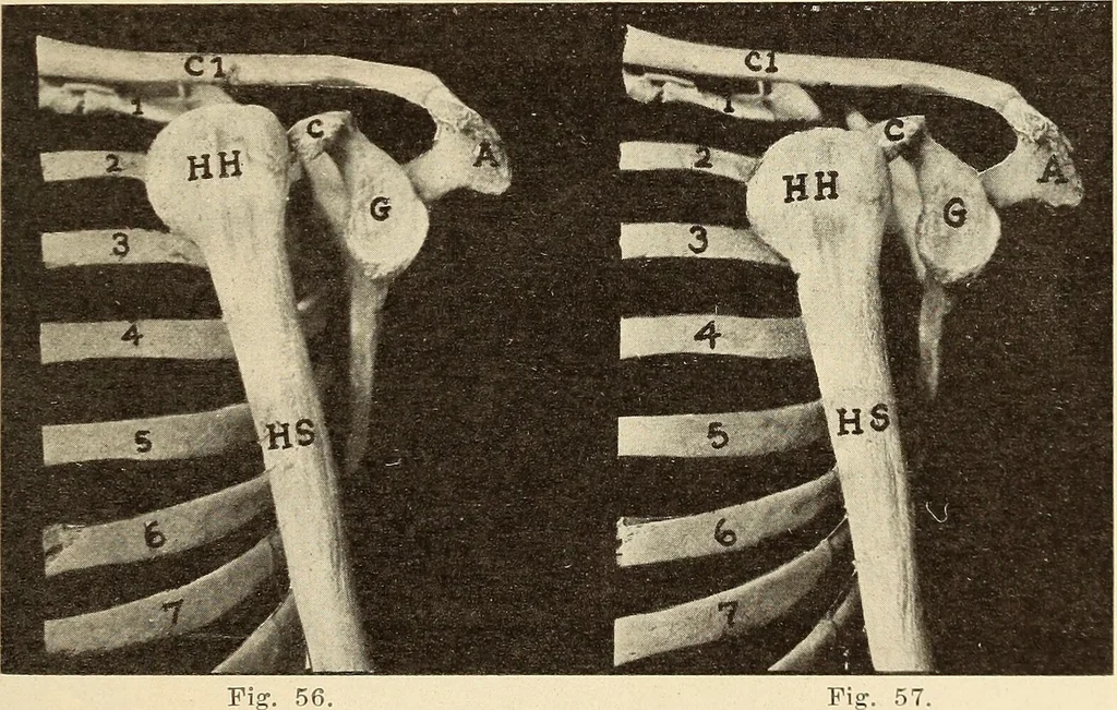 An illustration from Fractures and dislocations, diagnosis and treatment, 1915, leaf 78