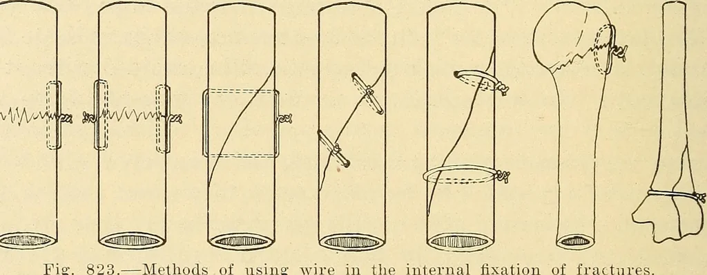 An illustration from Fractures and dislocations, diagnosis and treatment, 1915, leaf 787