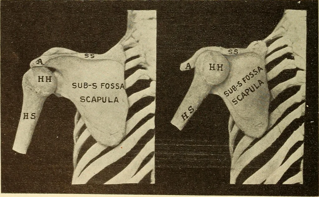 An illustration from Fractures and dislocations, diagnosis and treatment, 1915, leaf 79