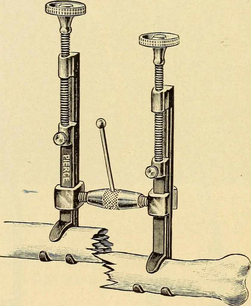 An illustration from Fractures and dislocations, diagnosis and treatment, 1915, leaf 791