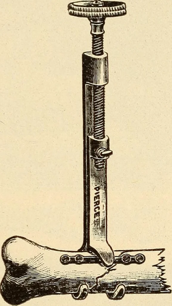 An illustration from Fractures and dislocations, diagnosis and treatment, 1915, leaf 792