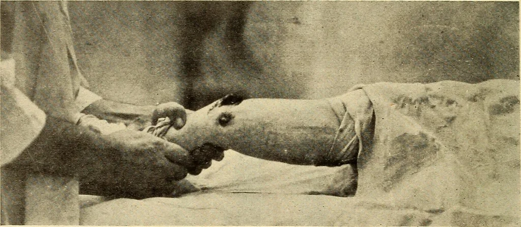 An illustration from Fractures and dislocations, diagnosis and treatment, 1915, leaf 793