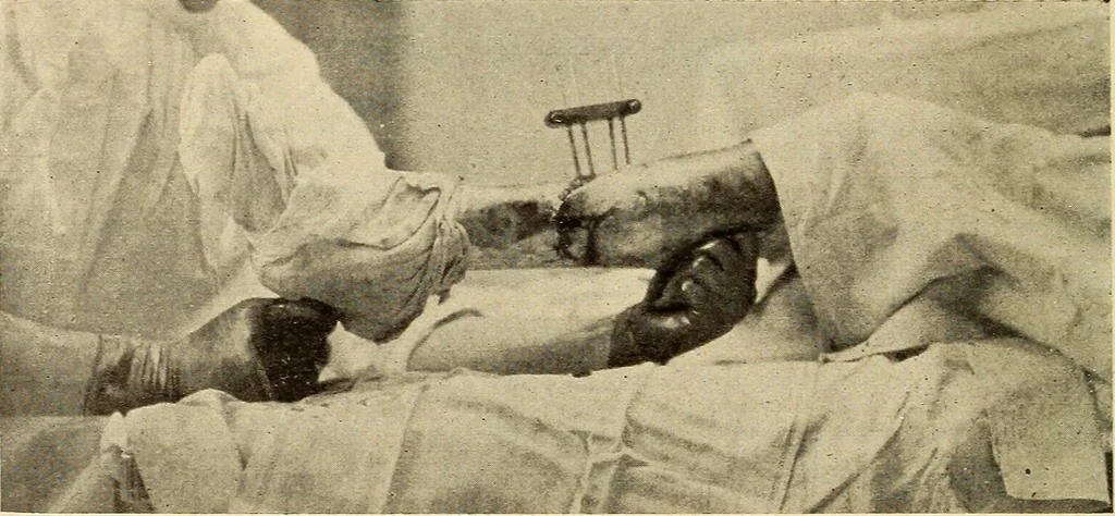 An illustration from Fractures and dislocations, diagnosis and treatment, 1915, leaf 793
