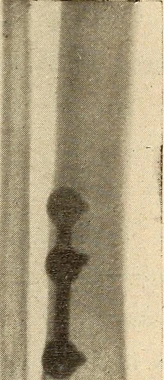 An illustration from Fractures and dislocations, diagnosis and treatment, 1915, leaf 796