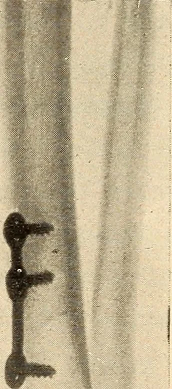 An illustration from Fractures and dislocations, diagnosis and treatment, 1915, leaf 796