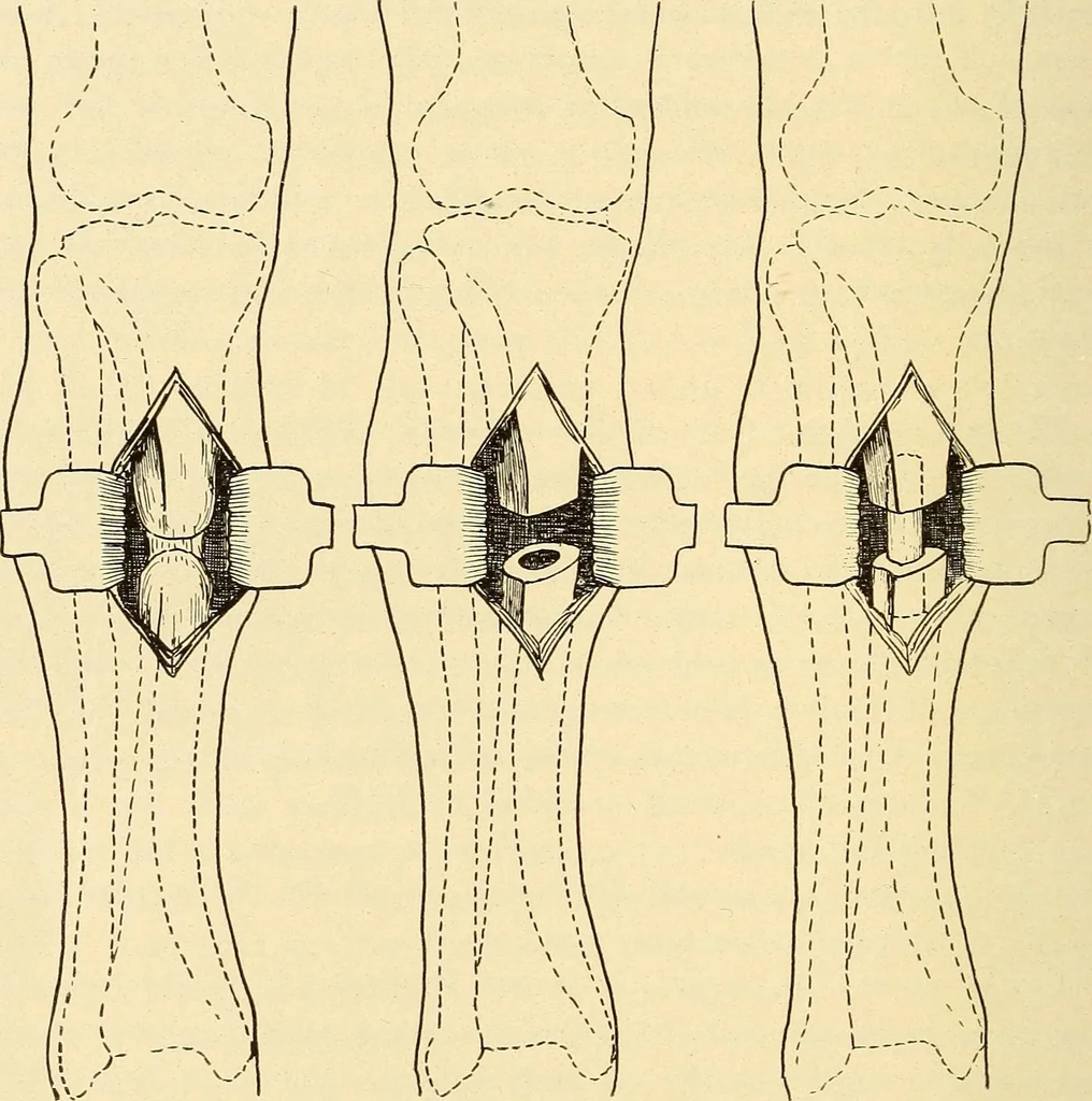 An illustration from Fractures and dislocations, diagnosis and treatment, 1915, leaf 807