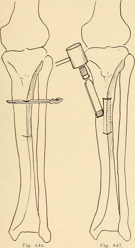 An illustration from Fractures and dislocations, diagnosis and treatment, 1915, leaf 808