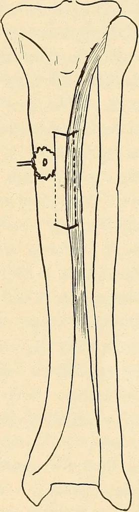 An illustration from Fractures and dislocations, diagnosis and treatment, 1915, leaf 808