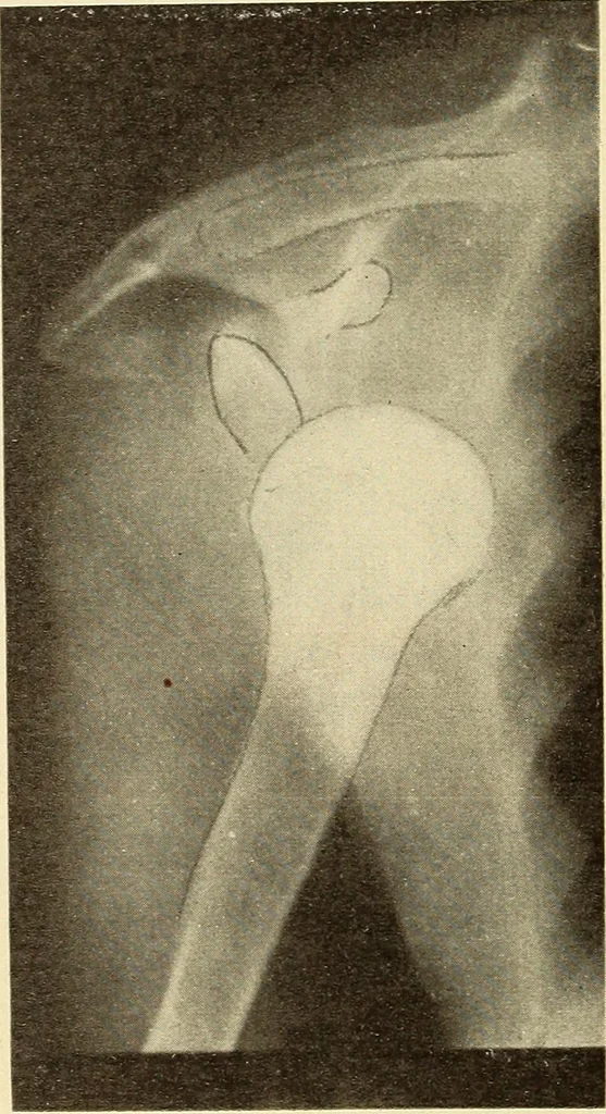 An illustration from Fractures and dislocations, diagnosis and treatment, 1915, leaf 81