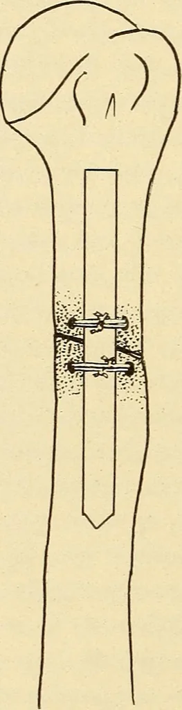 An illustration from Fractures and dislocations, diagnosis and treatment, 1915, leaf 811
