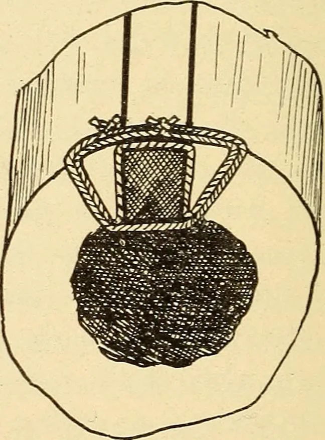 An illustration from Fractures and dislocations, diagnosis and treatment, 1915, leaf 811