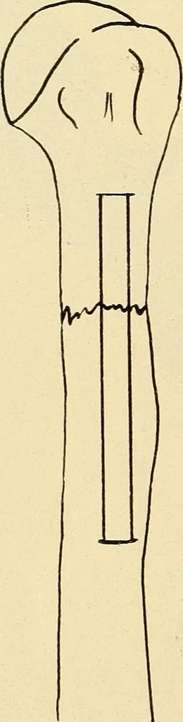 An illustration from Fractures and dislocations, diagnosis and treatment, 1915, leaf 813