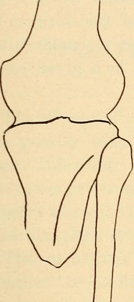 An illustration from Fractures and dislocations, diagnosis and treatment, 1915, leaf 816