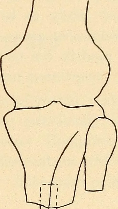 An illustration from Fractures and dislocations, diagnosis and treatment, 1915, leaf 816